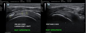 stem wave therapy vs shockwave therapy